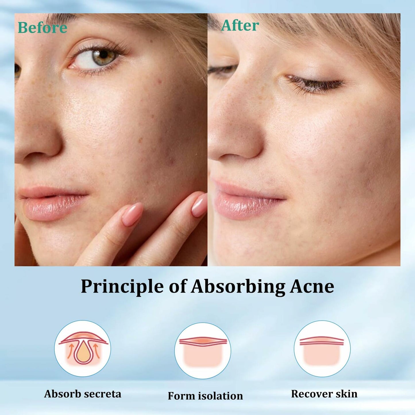 SHIVRISE Pimple Patch Hydrocolloid Acne Spot Cover Tea Tree Oil 36 Count